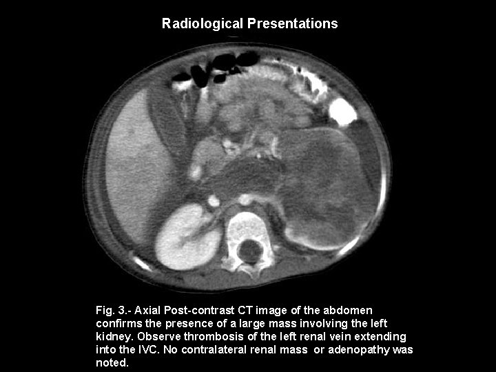 Radiological Presentations Fig. 3. - Axial Post-contrast CT image of the abdomen confirms the