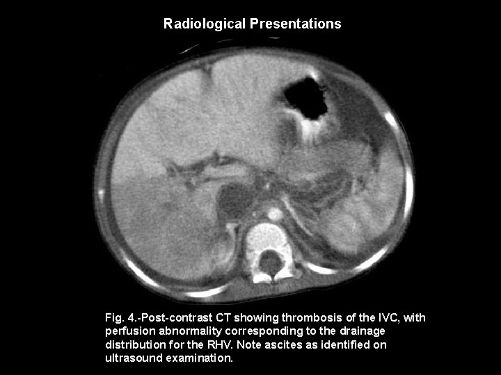 Radiological Presentations Fig. 4. -Post-contrast CT showing thrombosis of the IVC, with perfusion abnormality