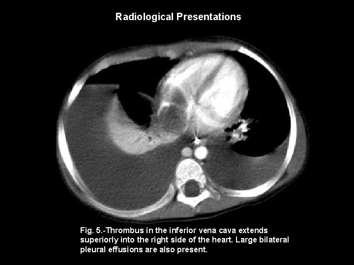 Radiological Presentations Fig. 5. -Thrombus in the inferior vena cava extends superiorly into the