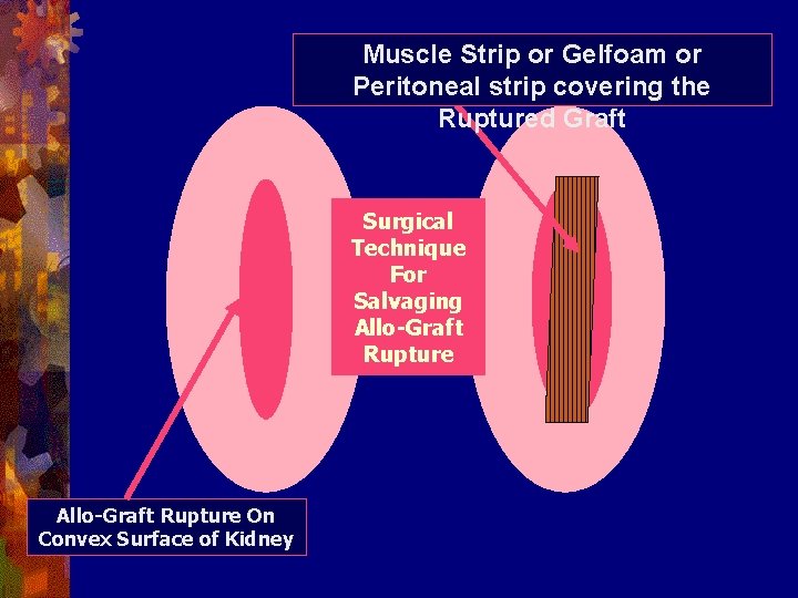 Muscle Strip or Gelfoam or Peritoneal strip covering the Ruptured Graft Surgical Technique For