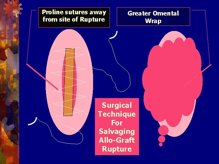 Proline sutures away from site of Rupture Greater Omental Wrap Surgical Technique For Salvaging