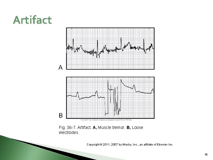 Artifact Fig. 36 -7. Artifact. A, Muscle tremor. B, Loose electrodes. Copyright © 2011,