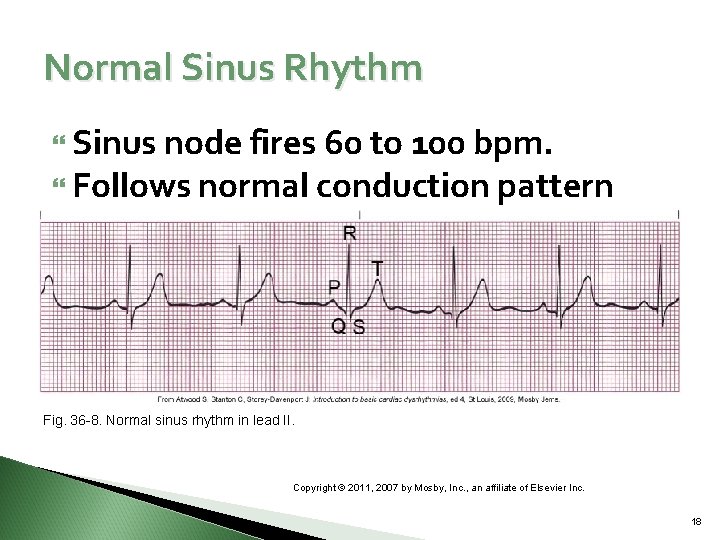 Normal Sinus Rhythm Sinus node fires 60 to 100 bpm. Follows normal conduction pattern