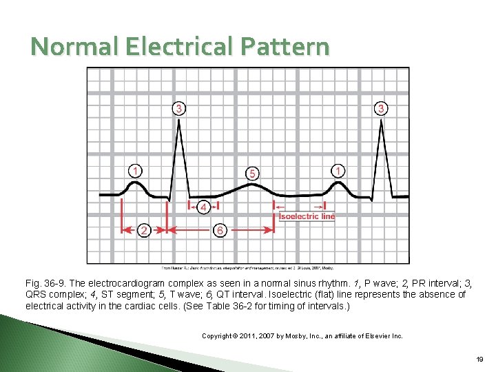 Normal Electrical Pattern Fig. 36 -9. The electrocardiogram complex as seen in a normal