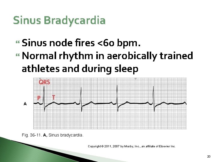 Sinus Bradycardia Sinus node fires <60 bpm. Normal rhythm in aerobically trained athletes and