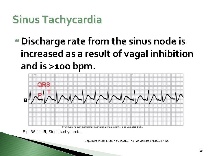 Sinus Tachycardia Discharge rate from the sinus node is increased as a result of