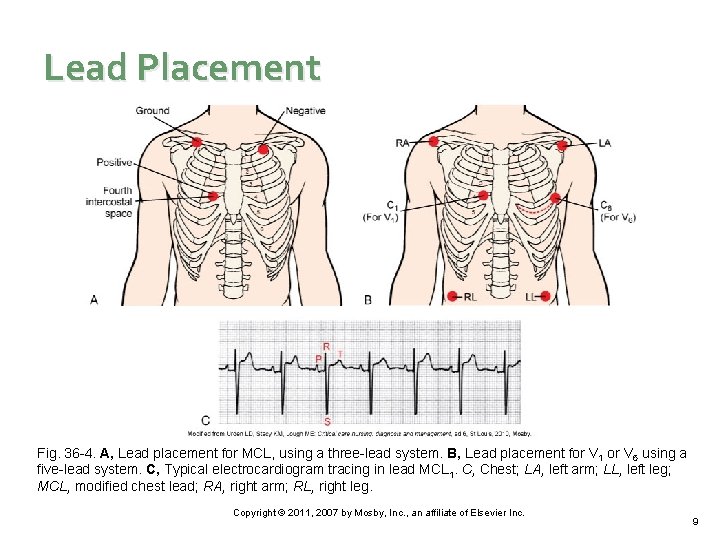 Lead Placement Fig. 36 -4. A, Lead placement for MCL, using a three-lead system.