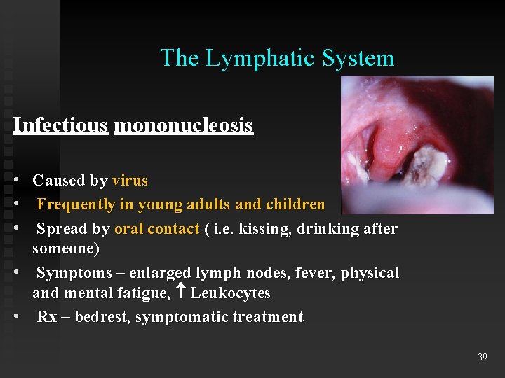 The Lymphatic System Infectious mononucleosis • • • Caused by virus Frequently in young