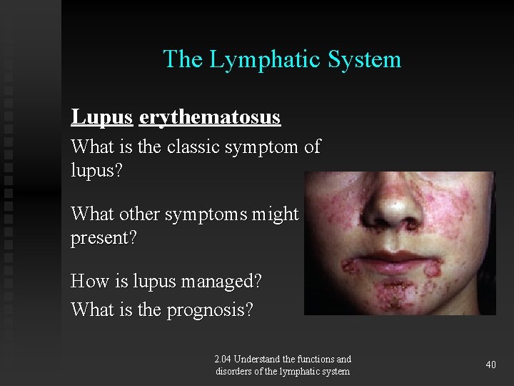 The Lymphatic System Lupus erythematosus What is the classic symptom of lupus? What other