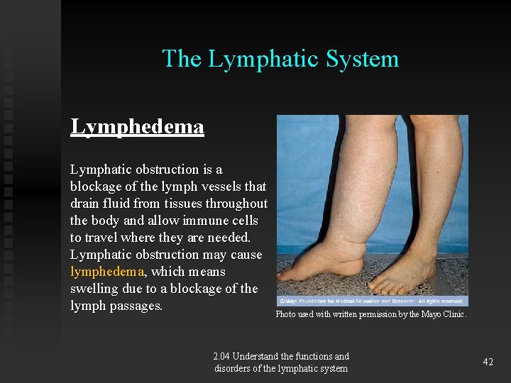 The Lymphatic System Lymphedema Lymphatic obstruction is a blockage of the lymph vessels that