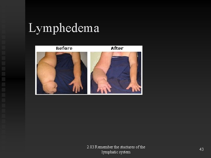 Lymphedema 2. 03 Remember the stuctures of the lymphatic system 43 