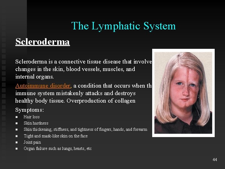 The Lymphatic System Scleroderma is a connective tissue disease that involves changes in the