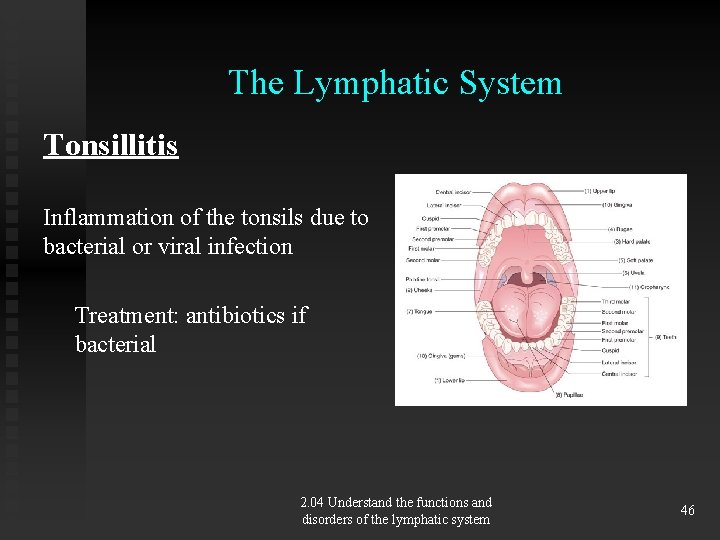 The Lymphatic System Tonsillitis Inflammation of the tonsils due to bacterial or viral infection