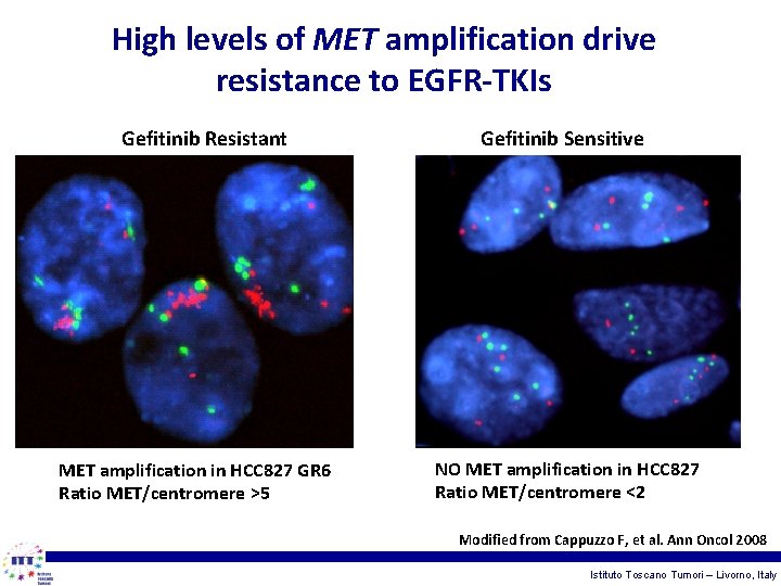 High levels of MET amplification drive resistance to EGFR-TKIs Gefitinib Resistant MET amplification in