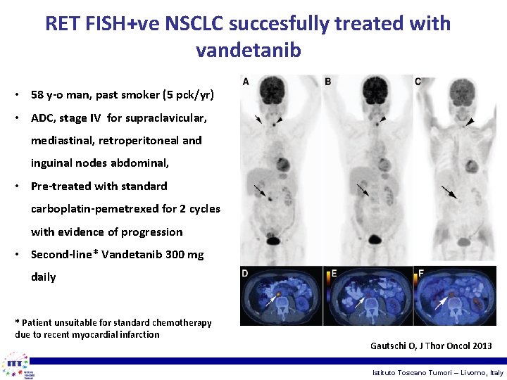 RET FISH+ve NSCLC succesfully treated with vandetanib • 58 y-o man, past smoker (5