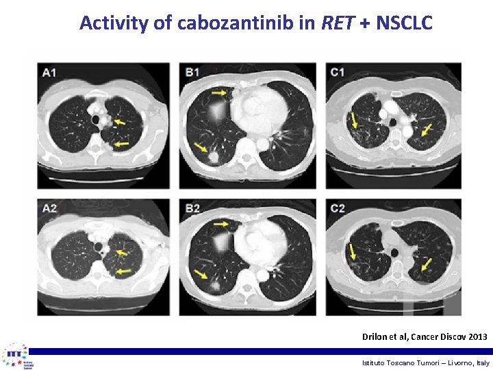 Activity of cabozantinib in RET + NSCLC Drilon et al, Cancer Discov 2013 Istituto