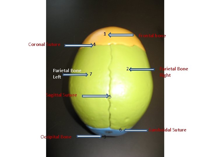 1 Coronal Suture Parietal Bone Left Frontal bone 4 2 7 Sagittal Suture 5