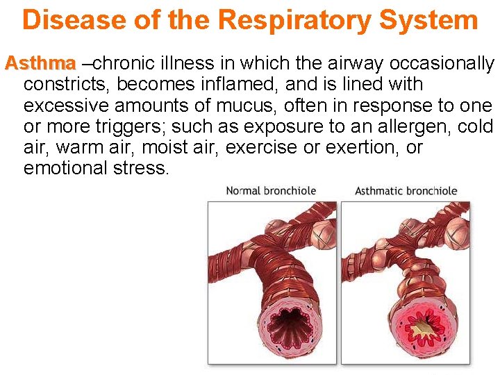 Disease of the Respiratory System Asthma –chronic illness in which the airway occasionally constricts,