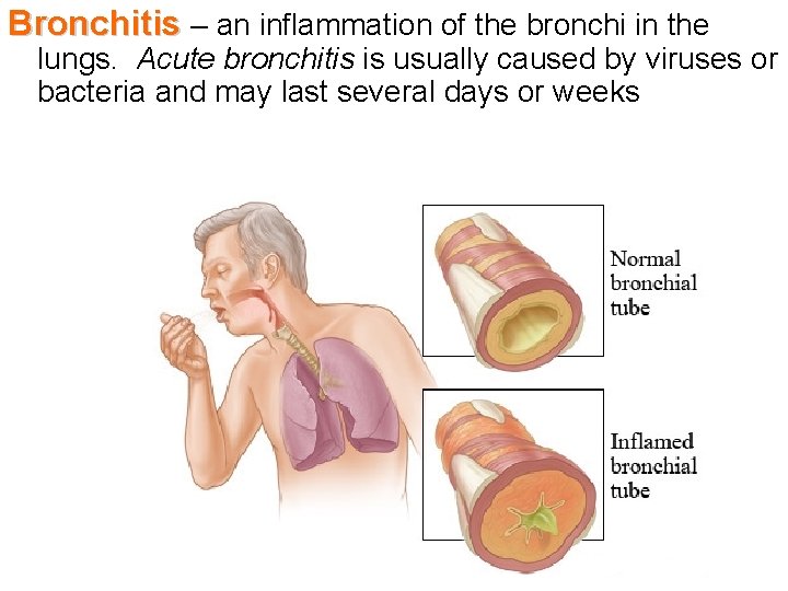 Bronchitis – an inflammation of the bronchi in the lungs. Acute bronchitis is usually