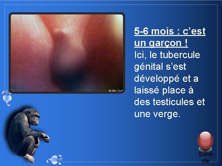 5 -6 mois : c’est un garçon ! Ici, le tubercule génital s’est développé