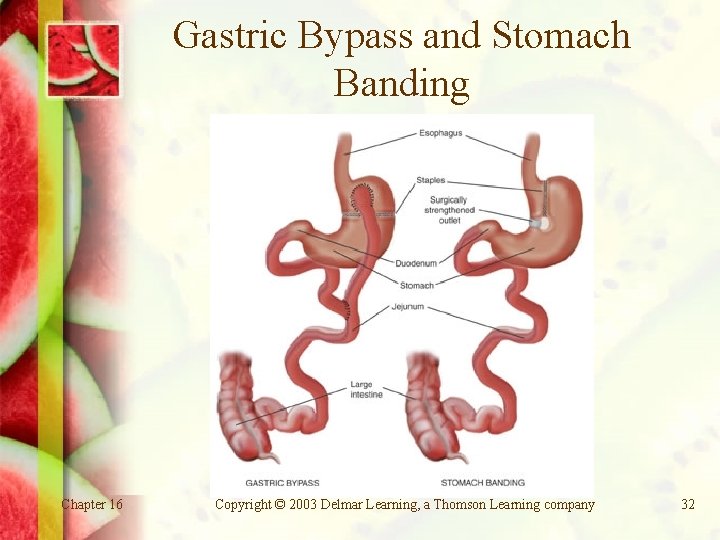 Gastric Bypass and Stomach Banding Chapter 16 Copyright © 2003 Delmar Learning, a Thomson