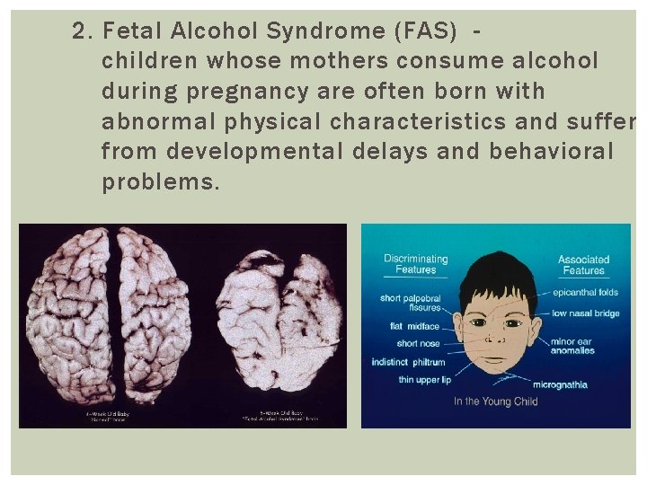2. Fetal Alcohol Syndrome (FAS) children whose mothers consume alcohol during pregnancy are often