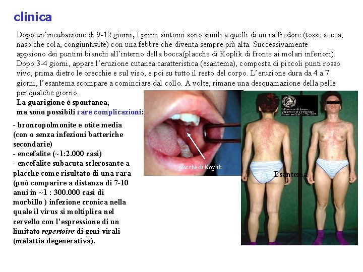 clinica Dopo un’incubazione di 9 -12 giorni, I primi sintomi sono simili a quelli