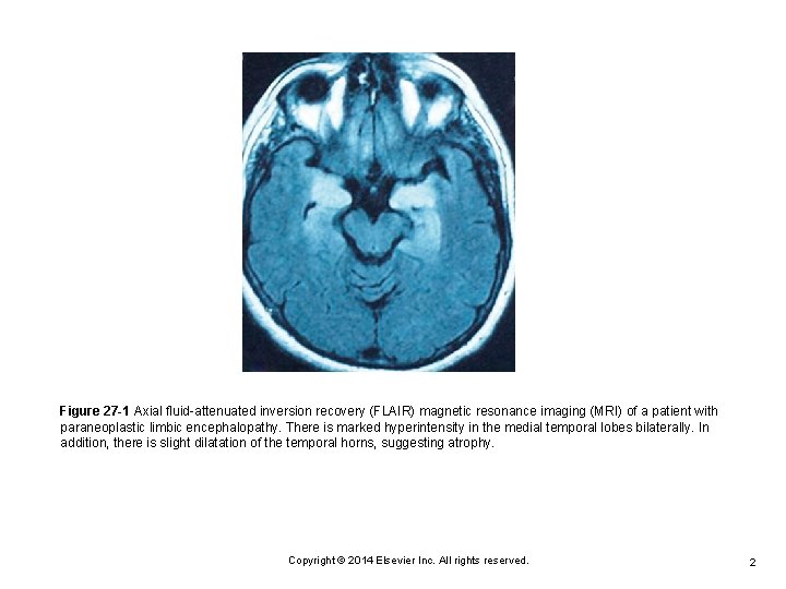 Figure 27 -1 Axial fluid-attenuated inversion recovery (FLAIR) magnetic resonance imaging (MRI) of a