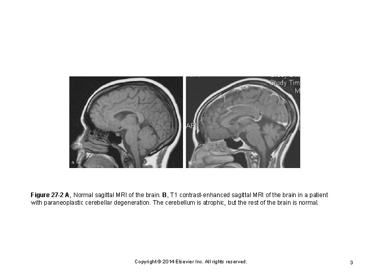 Figure 27 -2 A, Normal sagittal MRI of the brain. B, T 1 contrast-enhanced