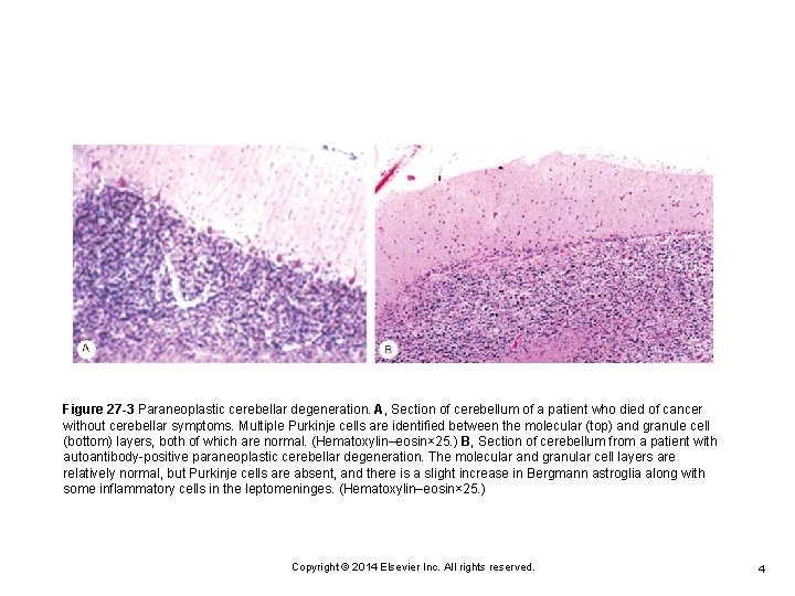 Figure 27 -3 Paraneoplastic cerebellar degeneration. A, Section of cerebellum of a patient who