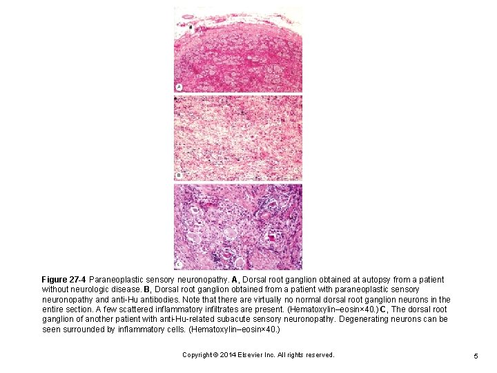 Figure 27 -4 Paraneoplastic sensory neuronopathy. A, Dorsal root ganglion obtained at autopsy from