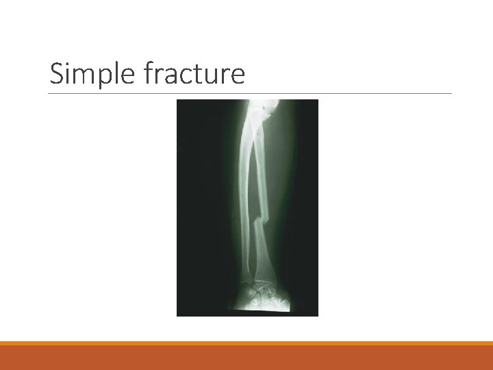 Simple fracture 