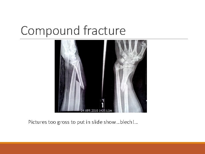 Compound fracture Pictures too gross to put in slide show…blech!… 
