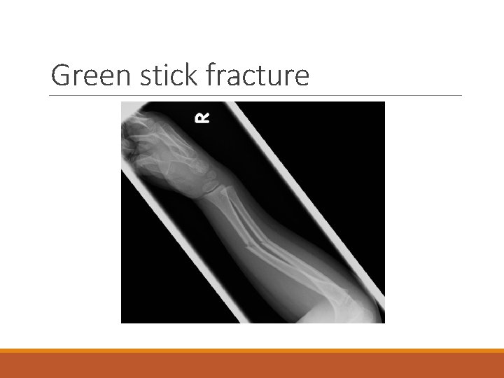 Green stick fracture 