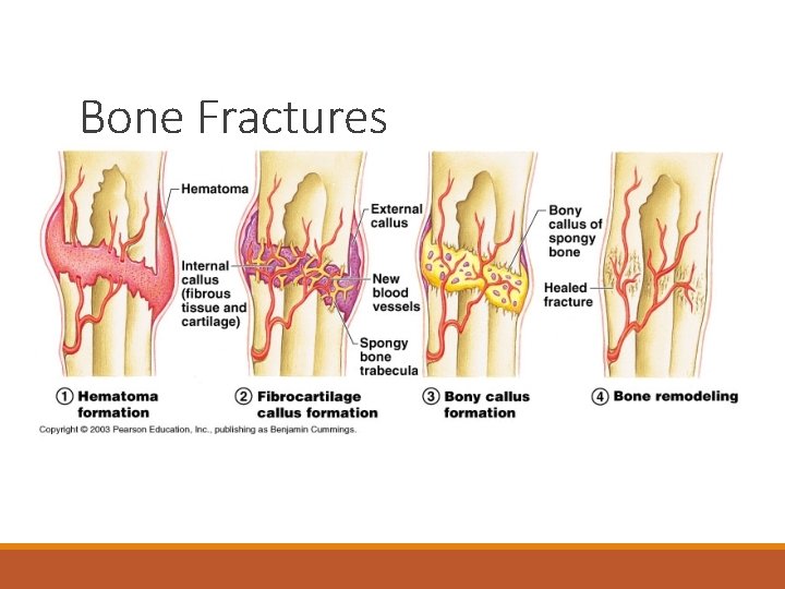 Bone Fractures 