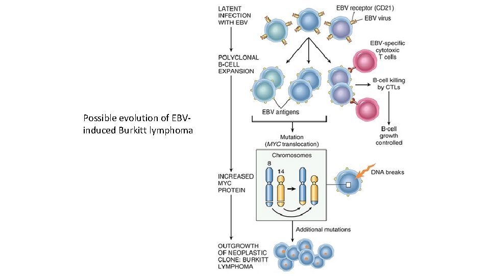 Possible evolution of EBVinduced Burkitt lymphoma 