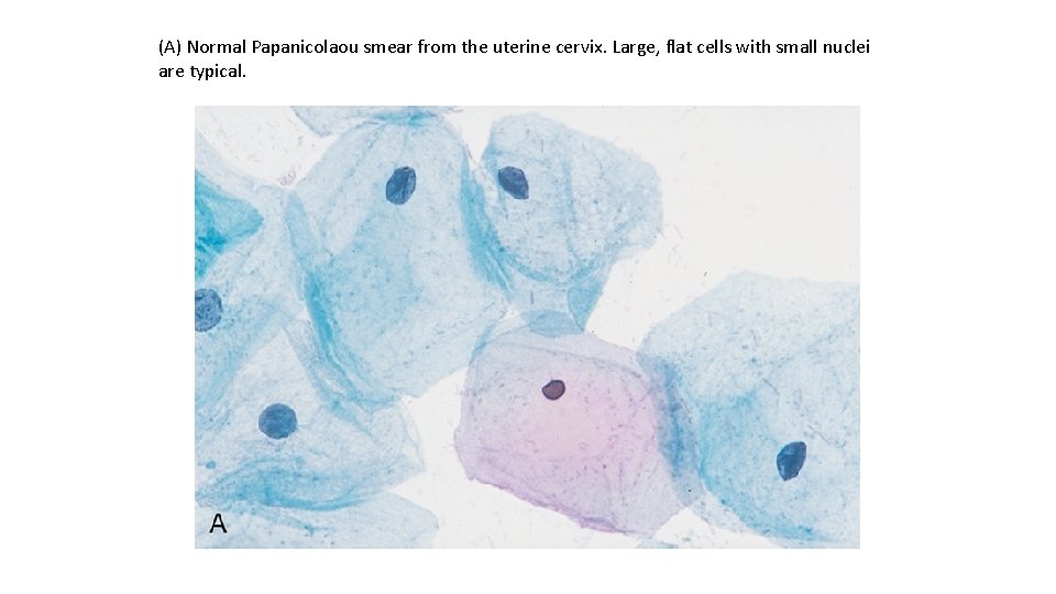 (A) Normal Papanicolaou smear from the uterine cervix. Large, flat cells with small nuclei