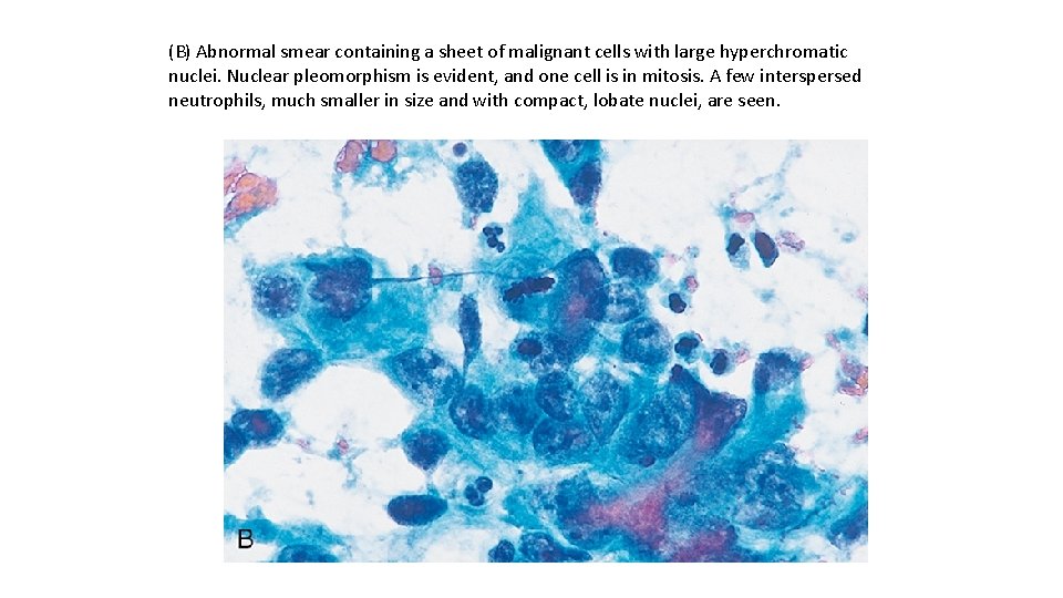 (B) Abnormal smear containing a sheet of malignant cells with large hyperchromatic nuclei. Nuclear