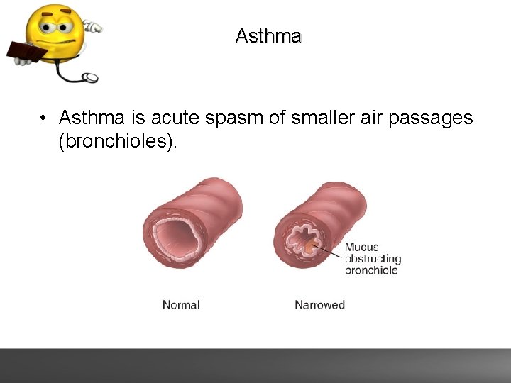 Asthma • Asthma is acute spasm of smaller air passages (bronchioles). 