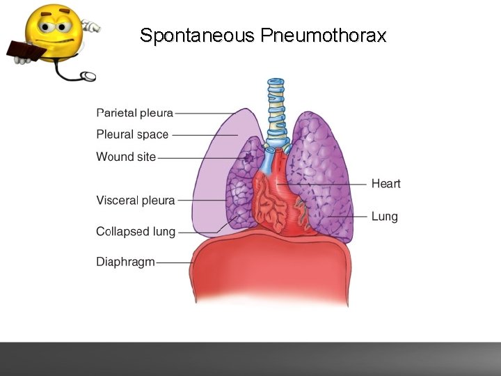 Spontaneous Pneumothorax 