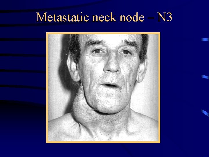 Metastatic neck node – N 3 