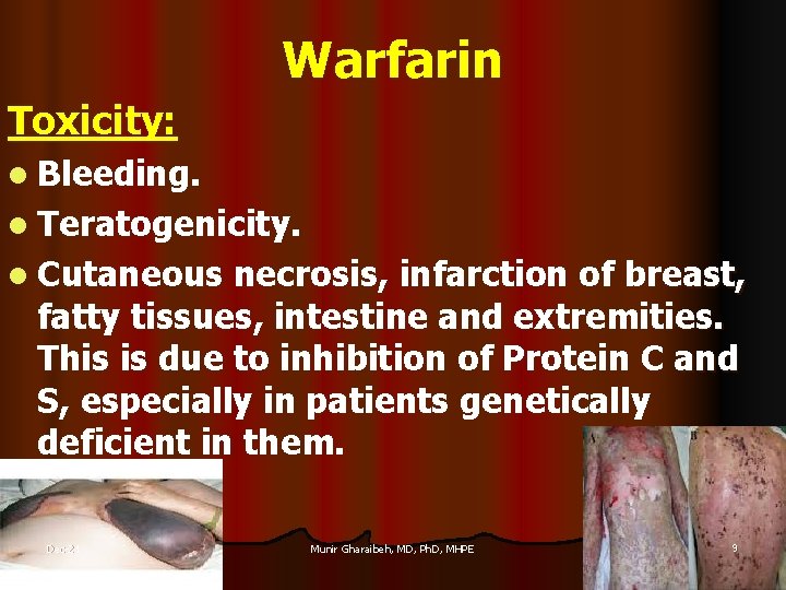 Warfarin Toxicity: l Bleeding. l Teratogenicity. l Cutaneous necrosis, infarction of breast, fatty tissues,