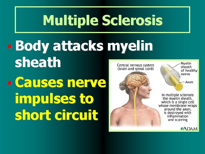 Multiple Sclerosis Body attacks myelin sheath Causes nerve impulses to short circuit 