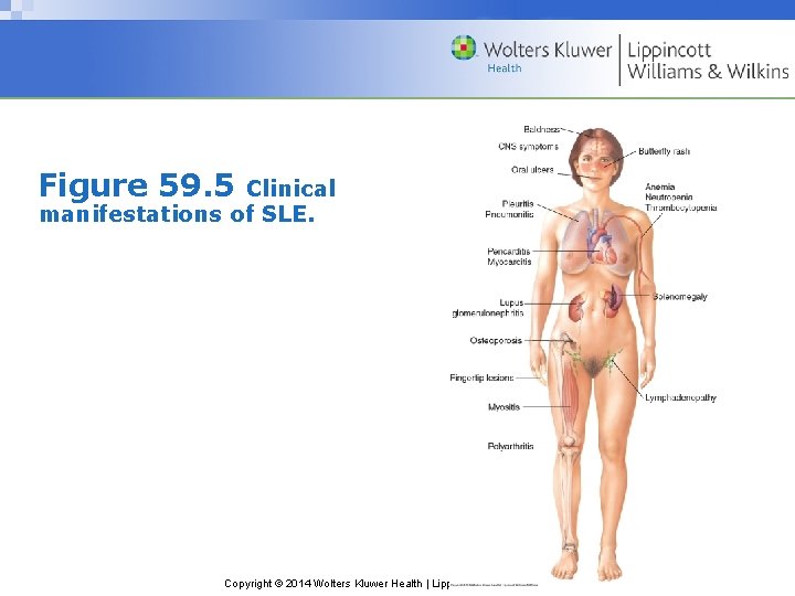Figure 59. 5 Clinical manifestations of SLE. Copyright © 2014 Wolters Kluwer Health |