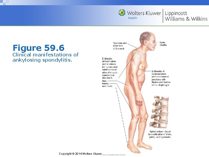 Figure 59. 6 Clinical manifestations of ankylosing spondylitis. Copyright © 2014 Wolters Kluwer Health