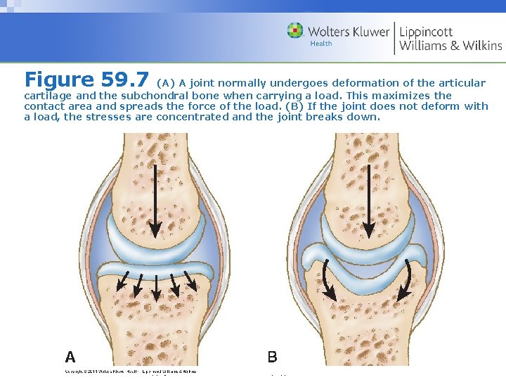 Figure 59. 7 (A) A joint normally undergoes deformation of the articular cartilage and