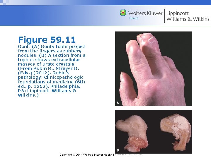 Figure 59. 11 Gout. (A) Gouty tophi project from the fingers as rubbery nodules.