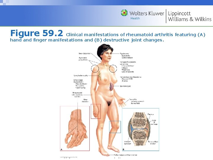 Figure 59. 2 Clinical manifestations of rheumatoid arthritis featuring (A) hand finger manifestations and