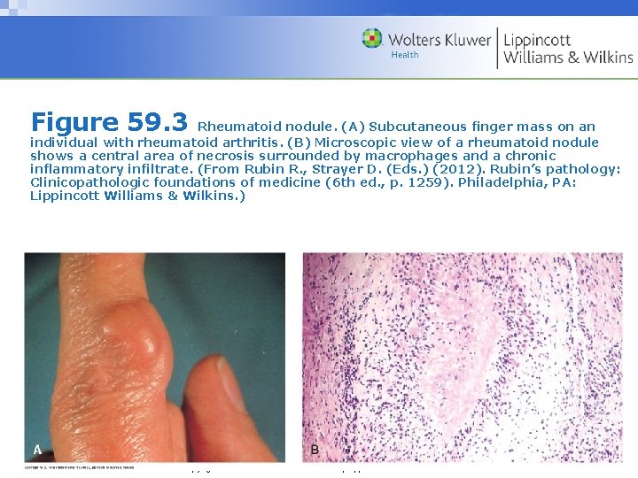 Figure 59. 3 Rheumatoid nodule. (A) Subcutaneous finger mass on an individual with rheumatoid