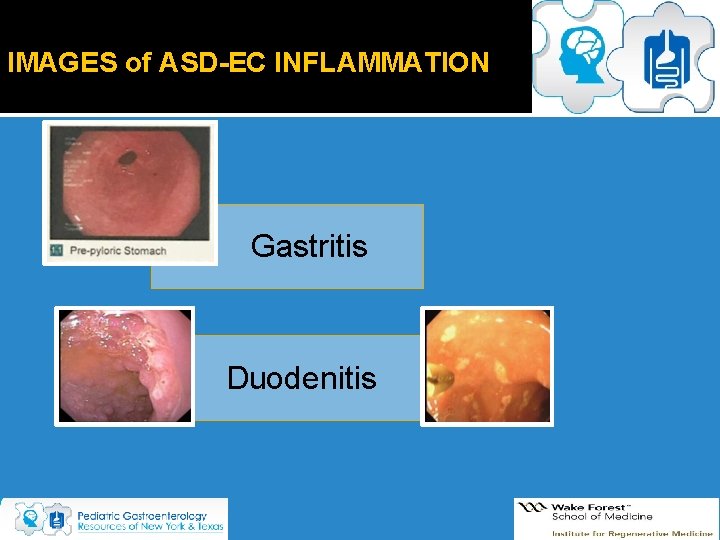 IMAGES of ASD-EC INFLAMMATION Gastritis Duodenitis IMAGES of ASD-EC INFLAMMATION Gastritis Duodenitis